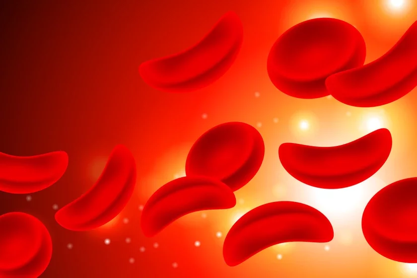 Sierpapadobna-kletkavaja aniemija. Erytracyty ŭ kryvi Sierpovidno-kletočnaja aniemija Eritrocity v krovotokie Sickle Cell Anemia Red cells in Blood Stream 