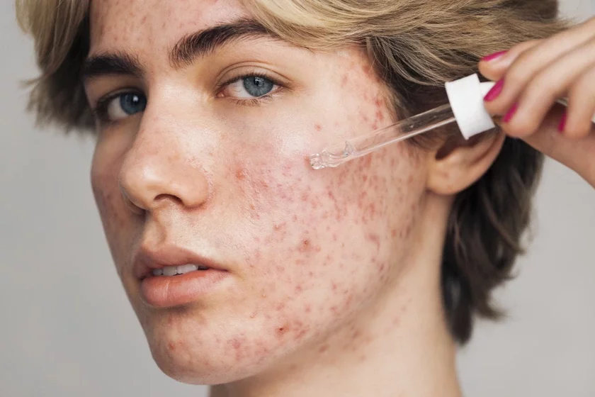 Прышчы Акнэ Прищи Acne